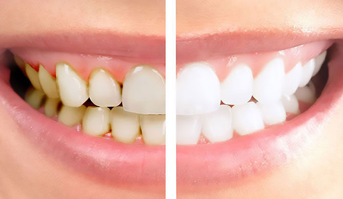 Узнайте, как отбелить зубы за меньшее время и с меньшим разочарованием!